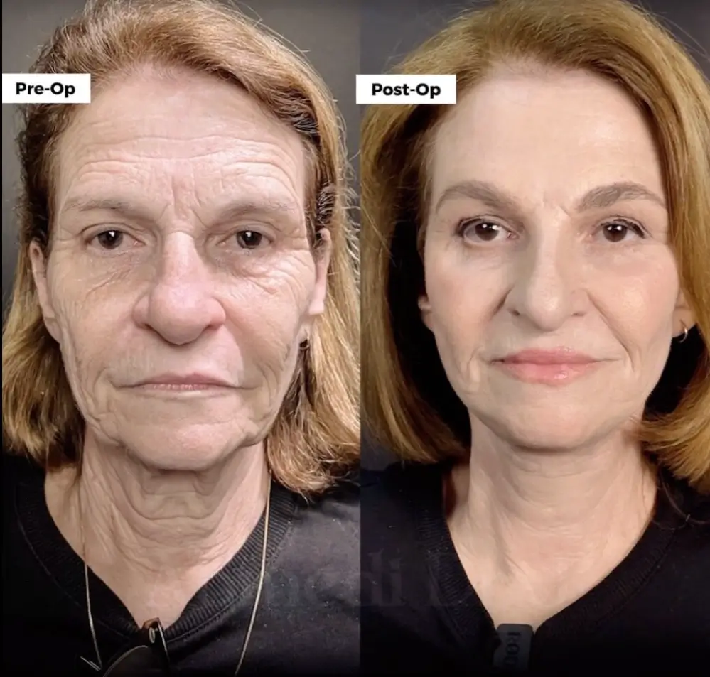 Getting a Facelift in Your 60s